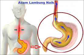 Illustration for article titled Obat Asam Lambung Naik Alami